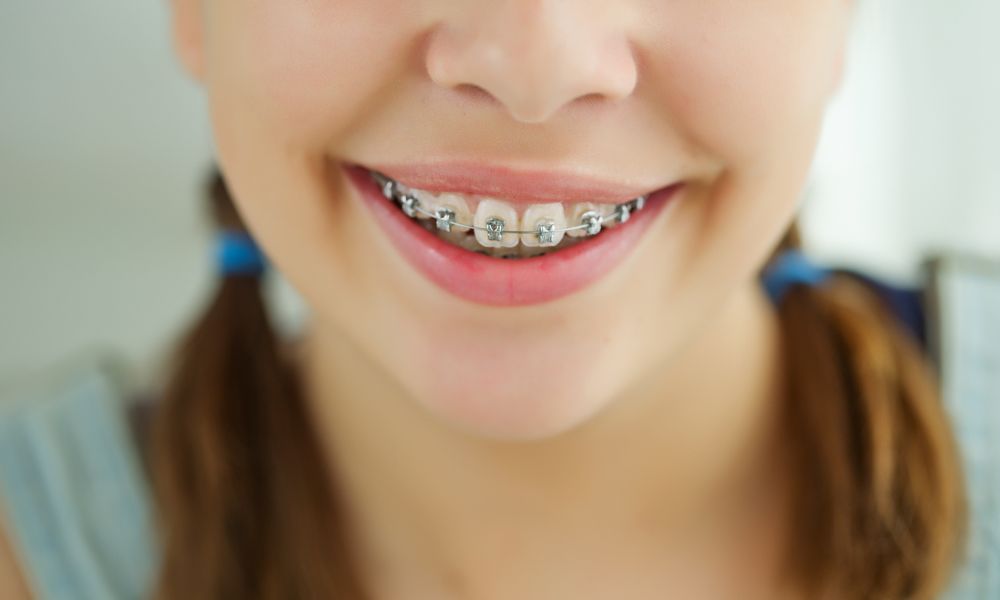 The Benefits of Getting Braces as a Teen